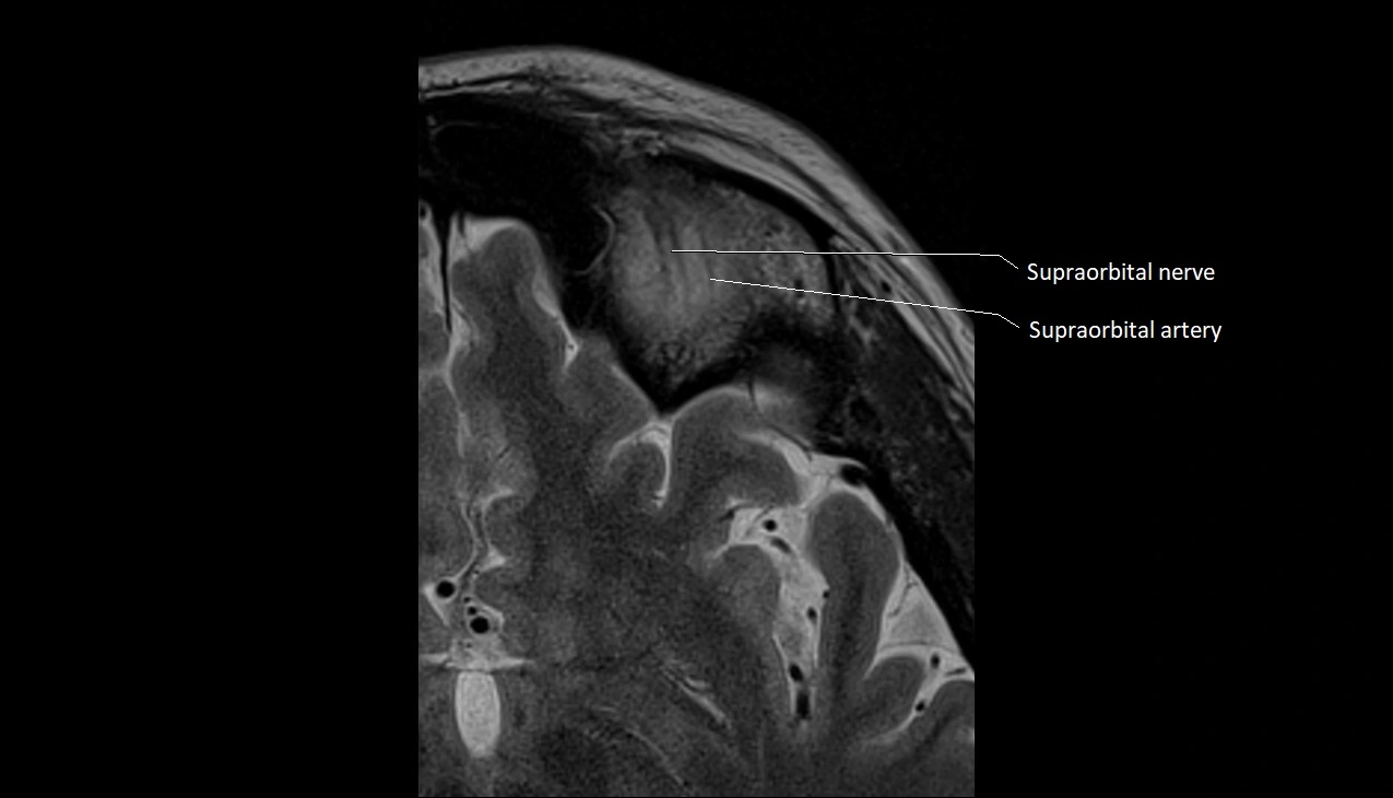 MRI Orbit axial cross sectional anatomy image 14.webp